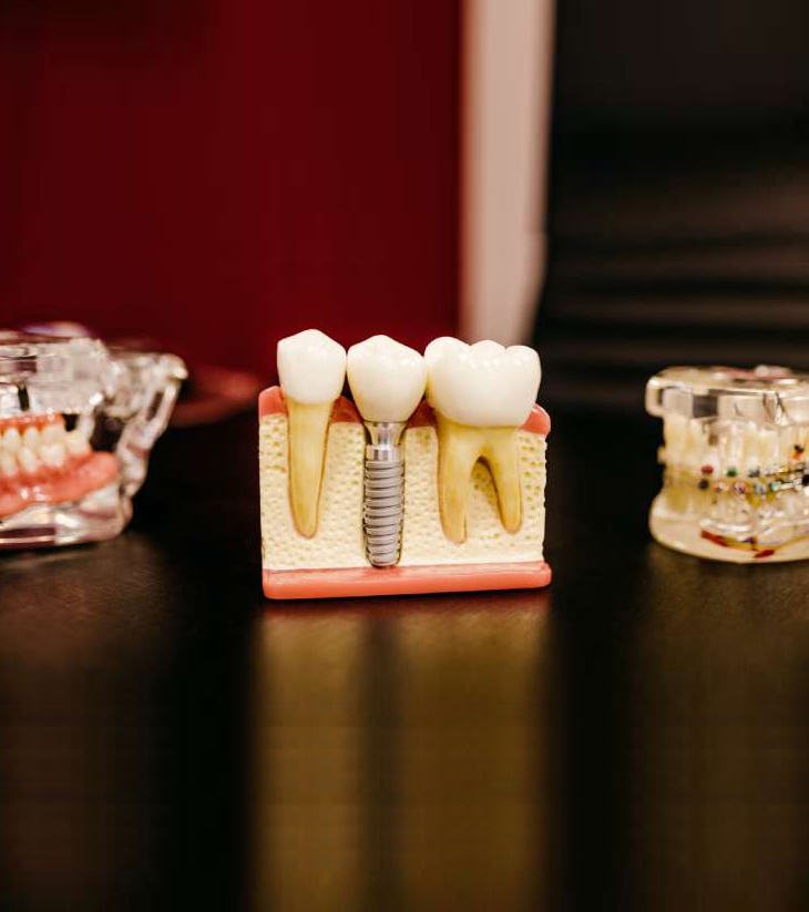 Dental implant model displaying three prosthetic teeth stages on display in dental office.