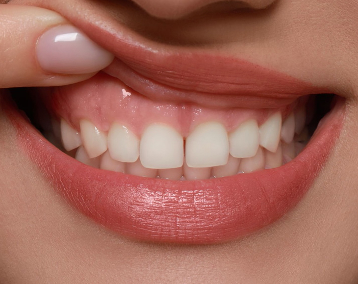 Close-up of a person's smile showing white teeth and natural lip color.