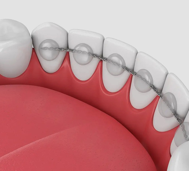 3D dental illustration showing teeth and gum anatomy in cross-section view.