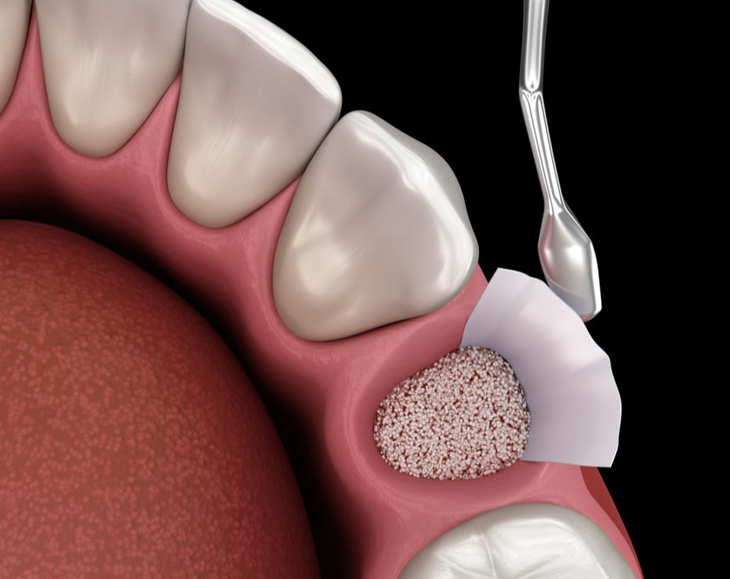 3D dental illustration showing bone graft material being placed into tooth socket during implant procedure.