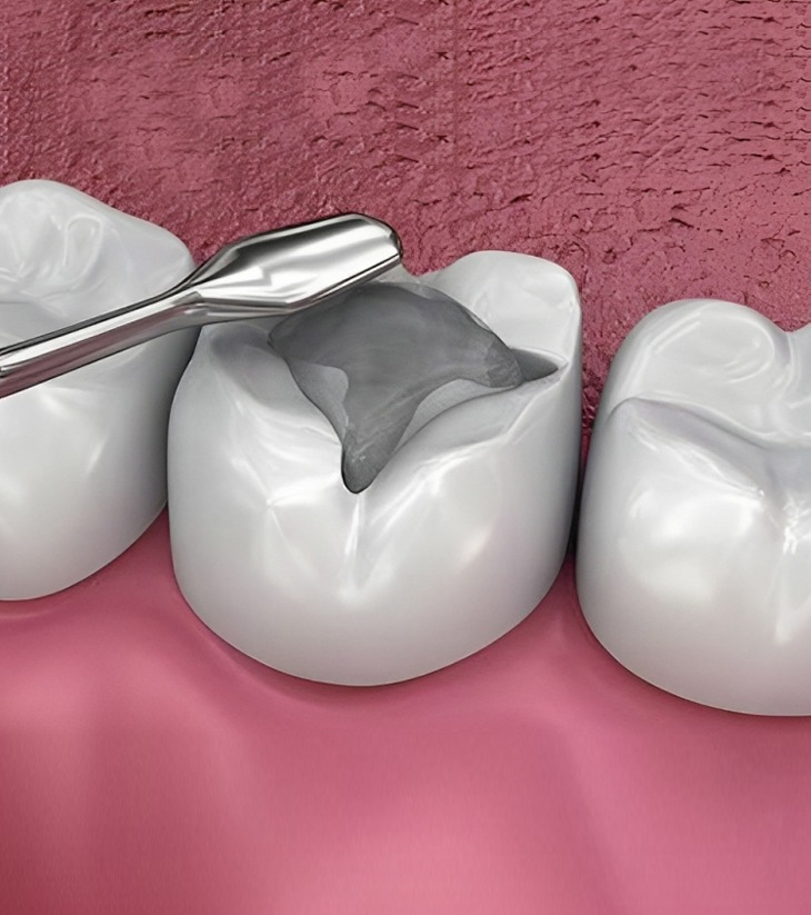 Dental explorer tool examining cavity on tooth model in clinical setting.