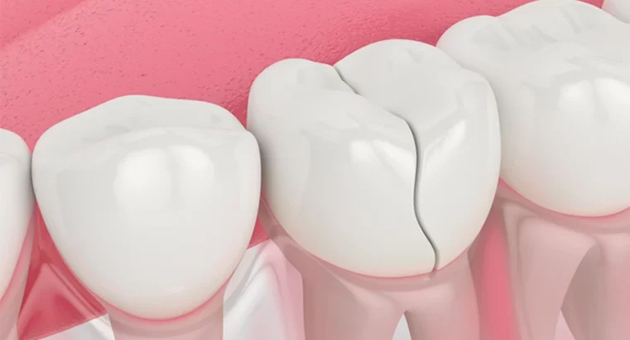 Dental crown illustration showing tooth restoration procedure with white porcelain crown on pink background.