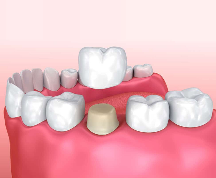 Dental crown restoration illustration showing tooth replacement procedure on pink gum model.