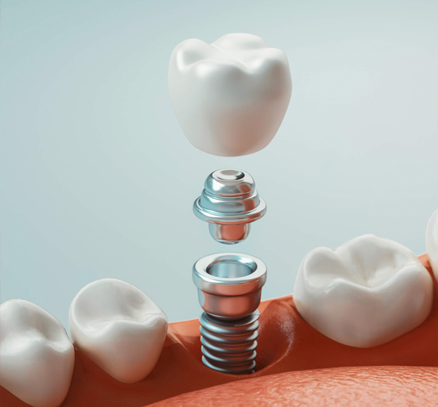 Dental implant cross-section diagram showing crown, abutment, screw, and implant components with tooth models.