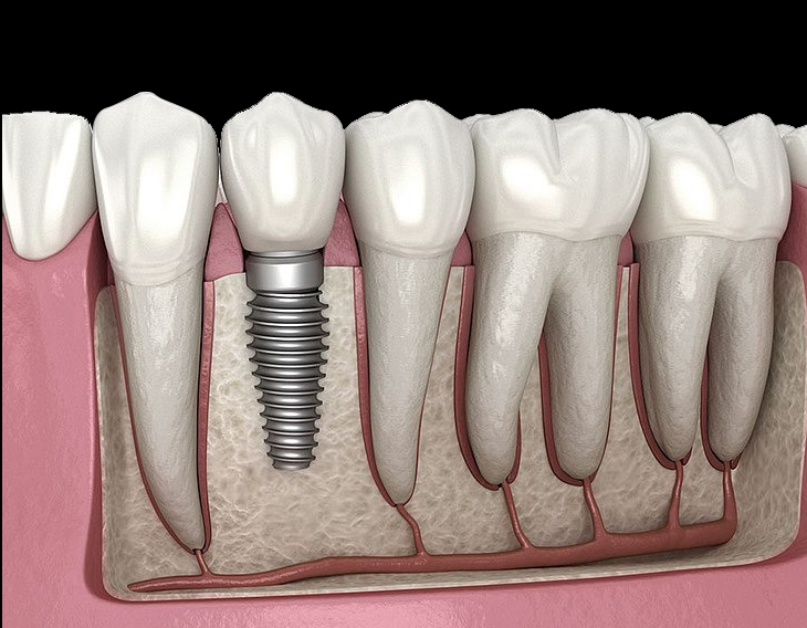 Dental implant illustration showing tooth replacement procedure with implant post and crown among natural teeth.