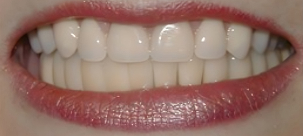 Close-up of healthy white teeth and smile with pink lips against neutral background.