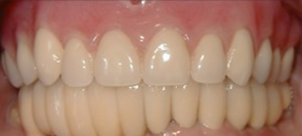 Close-up of healthy white teeth showing upper and lower dental alignment and bite.