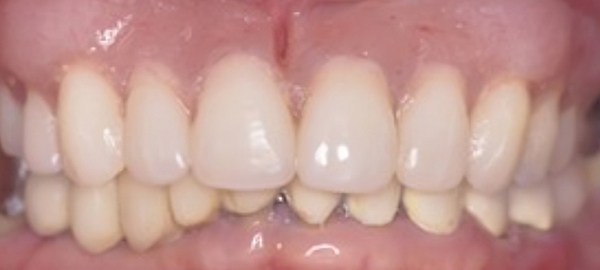 Close-up view of upper front teeth showing natural tooth color and alignment in dental office setting.