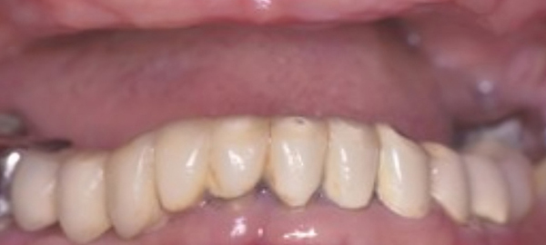 Close-up of natural-looking dental crown restorations on upper front teeth in dental office setting.