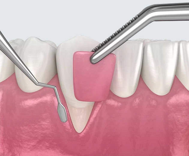 Dental probe examining gum recession between teeth in cross-section anatomical illustration.