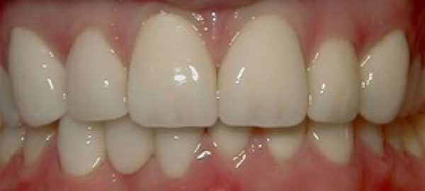 Close-up of upper front teeth showing natural white dental work and healthy gum line in clinical setting.