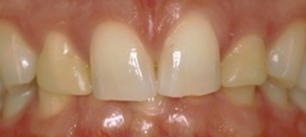 Close-up of upper front teeth showing dental work and gum health in clinical setting.