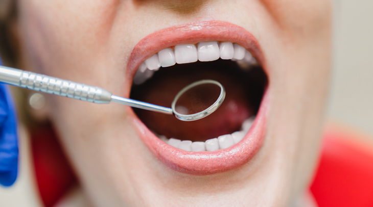Close-up of patient's open mouth during dental examination with mirror tool in clinical setting.