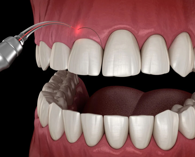 Dental laser treatment on upper front teeth with gum tissue visible in close-up view.
