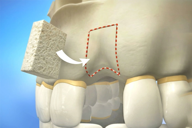 3D dental illustration showing bone graft procedure with implant placement in jawbone.