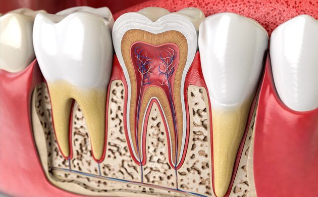 Anatomical cross-section diagram of tooth structure showing decay, pulp, and root canal layers.
