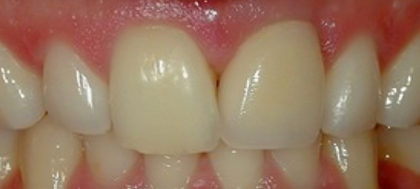 Close-up of upper front teeth showing dental work and natural tooth coloring in clinical setting.