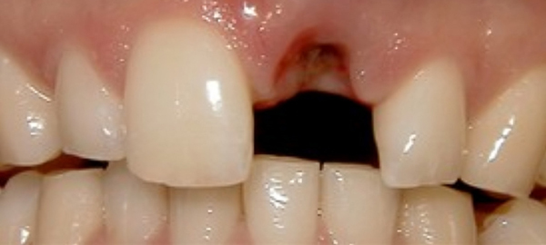 Close-up of upper front teeth showing a missing tooth gap between incisors.
