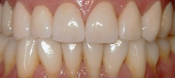 Close-up of healthy, white dental veneers on upper and lower teeth showing professional cosmetic dentistry results.