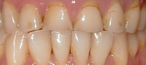 Close-up view of healthy natural teeth showing proper dental alignment and oral care results.