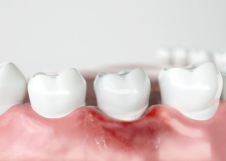 Three white dental crowns displayed on pink gum model showing restorative dentistry treatment options.